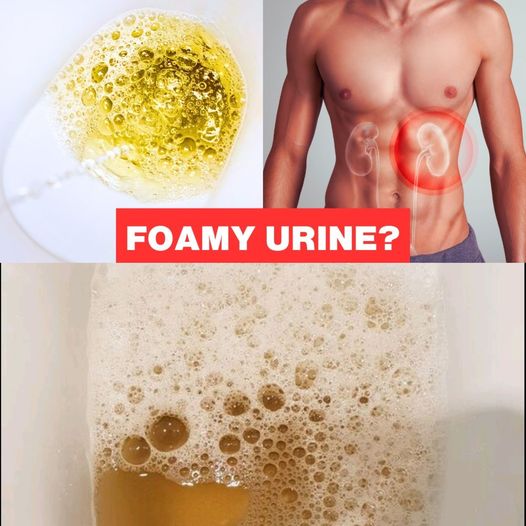 If Your Urine Is Foamy Like This, It Could Be A Warning Sign! (Proteinuria)