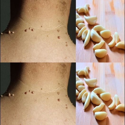 How to Easily Remove Skin Tags with Garlic