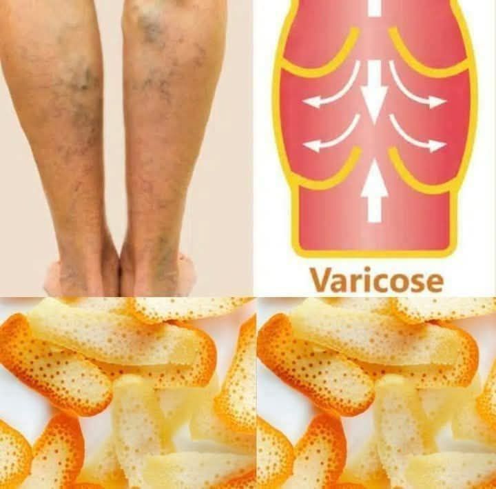 Orange peel helps boost circulation and reduce swelling, making it a great natural remedy for varicose veins.