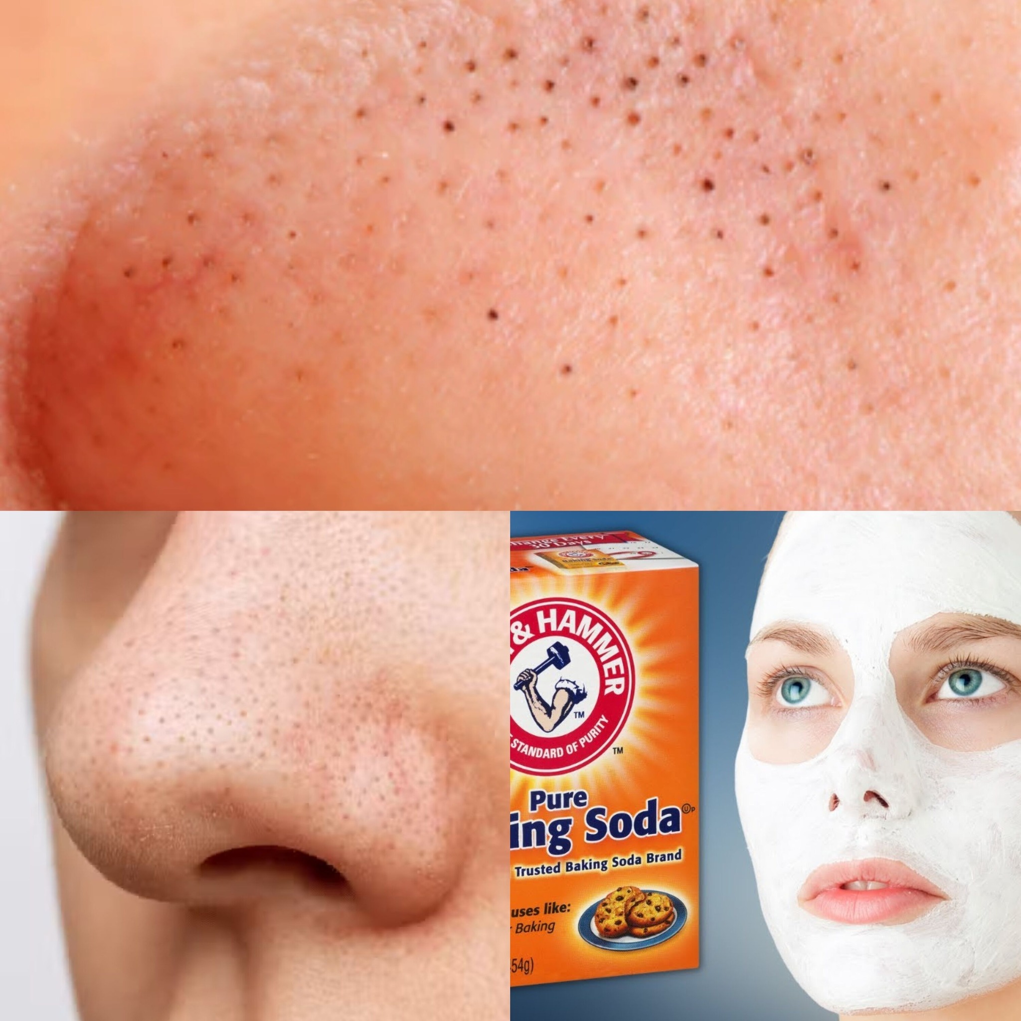 How to Remove Blackheads with Baking Soda