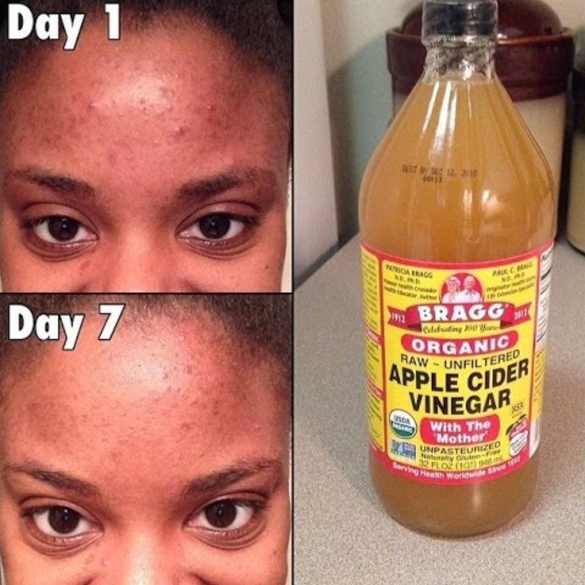 Refresh Your Skin with an Apple Cider Vinegar Face Routine