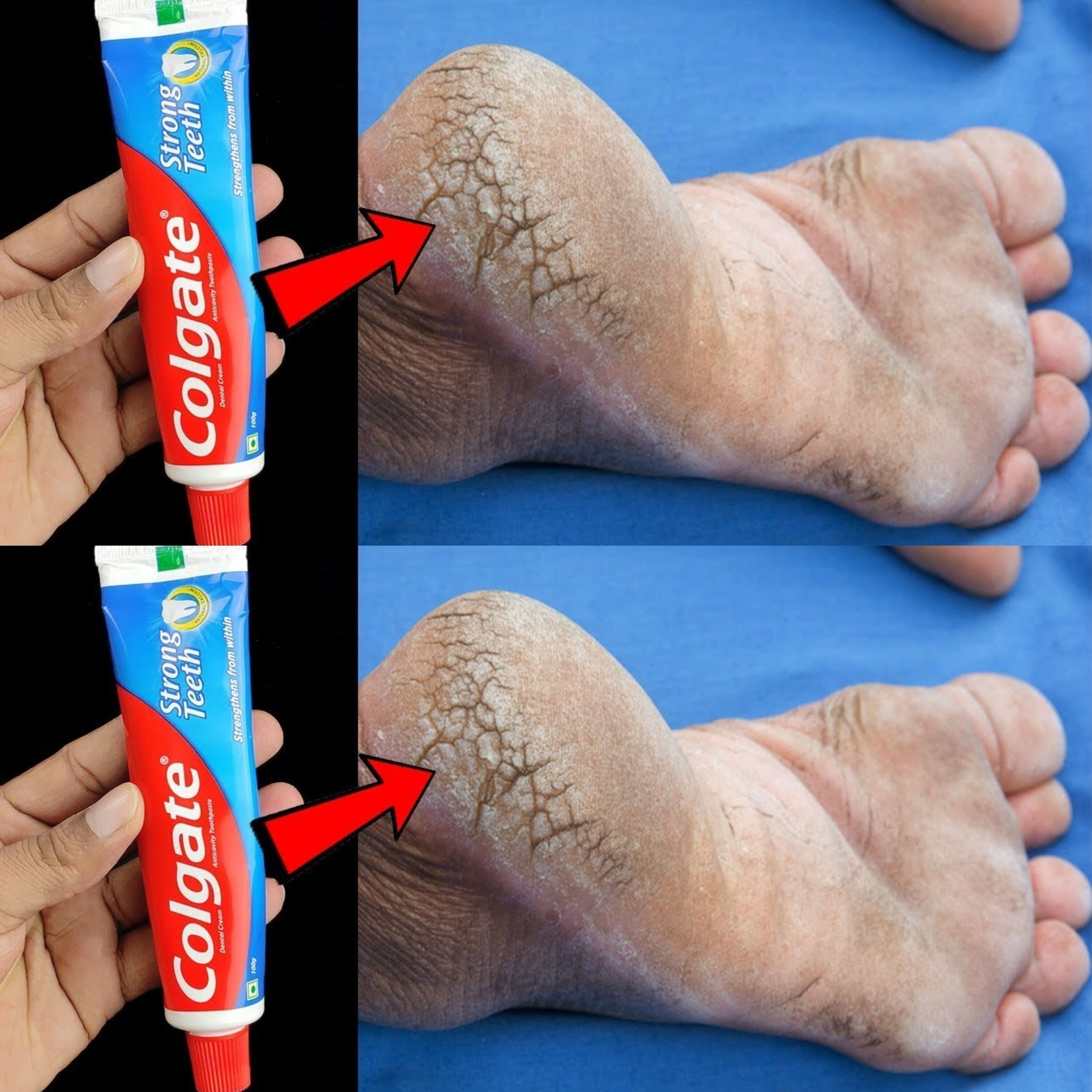 Remove Cracked Heels and Get Beautiful Feet Permanently in 3 Days with This Home Remedy Using Toothpaste 