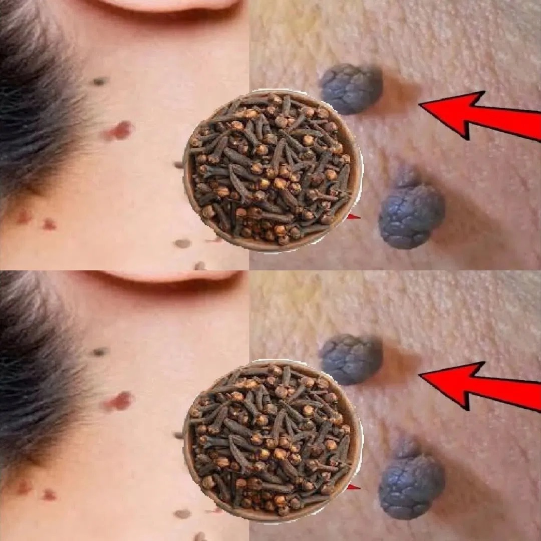 Cloves to Remove Skin Tags and Warts in Night: A Natural Remedy