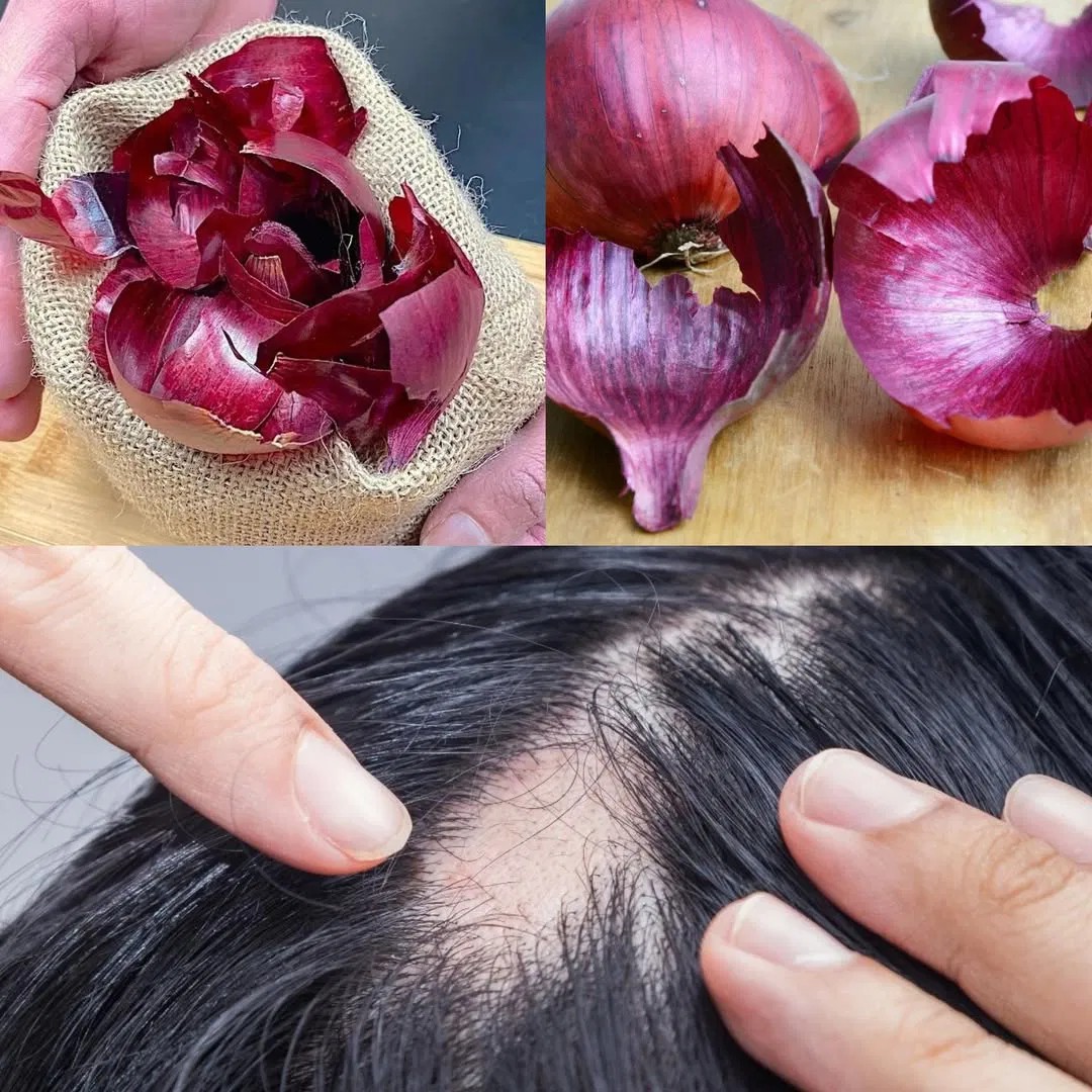 Regrow Hair Naturally: The Onion Peel Solution That’s Turning Heads!