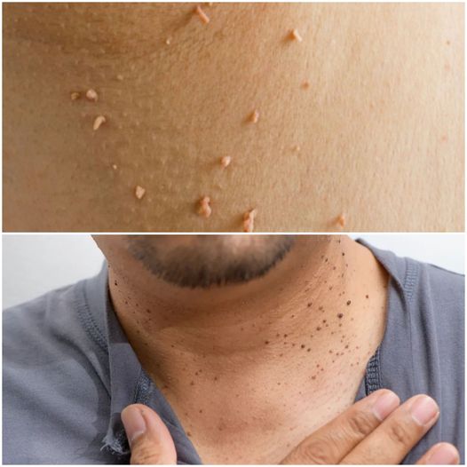 Skin Tags & Plantar Warts DISAPPEAR Overnight? [Best Home Remedies]