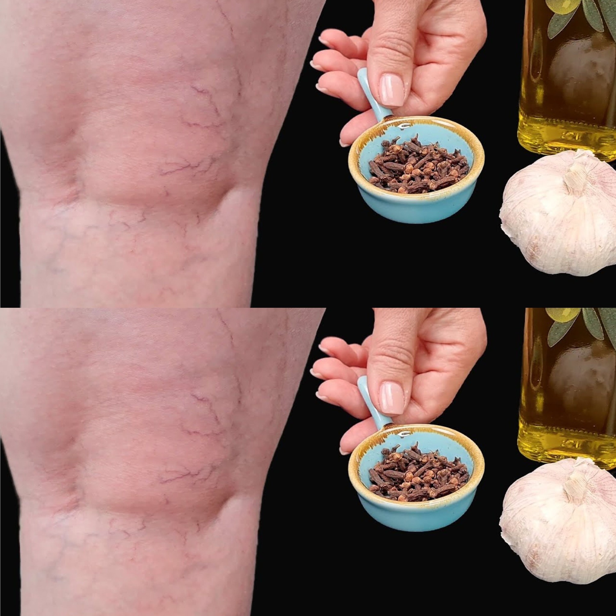 Leg Pain, Rheumatism, Varicose Veins, Arthritis – Natural Remedy with Cloves & Garlic! 