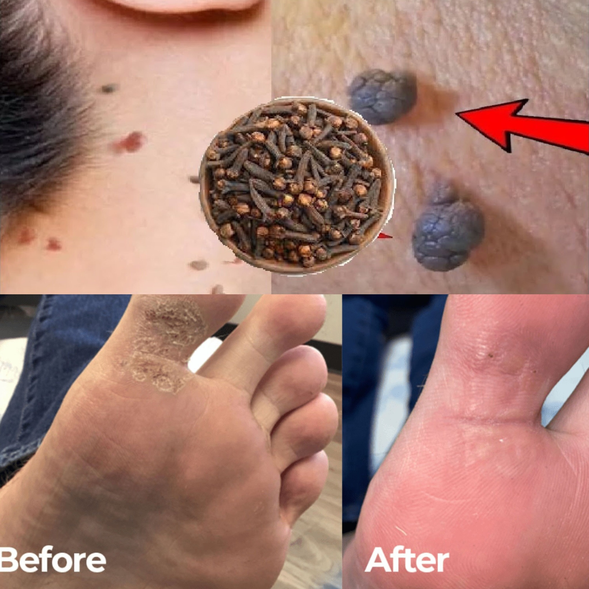 Cloves Remove Skin Tags & Warts in One Night! | How to Remove Skin Tags Naturally? 