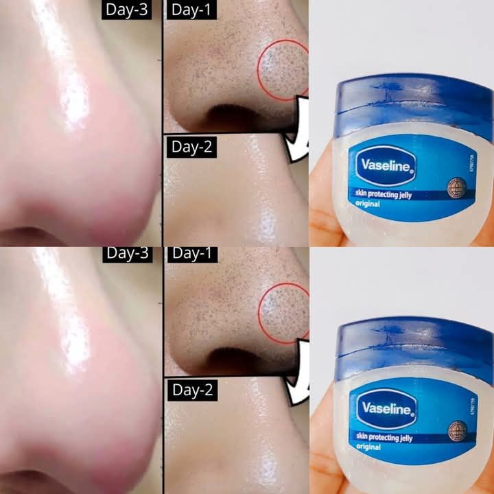 How to Remove Blackheads and Whiteheads Naturally with Vaseline