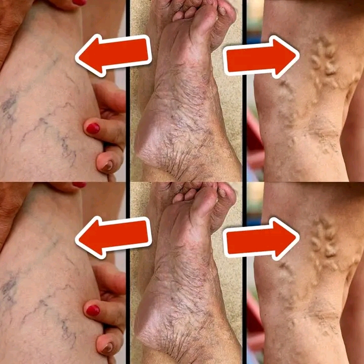 8 Natural Ways to Get Rid of Varicose Veins and Boost Blood Circulation 