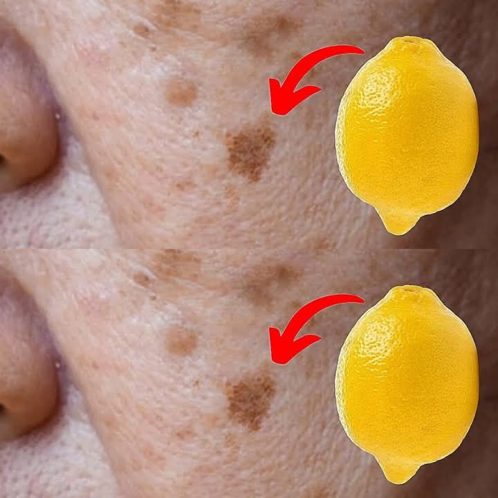 How to Remove Age Spots with Lemons