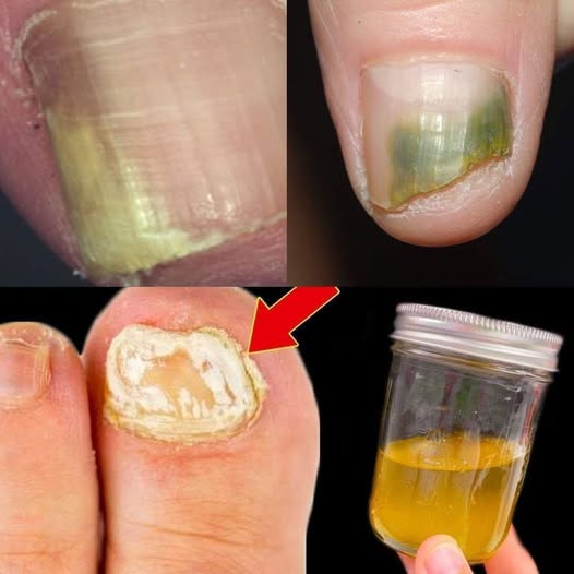 THIS is 100 Times More EFFECTIVE Than Other Home Remedies to Get Rid of Nail Fungus