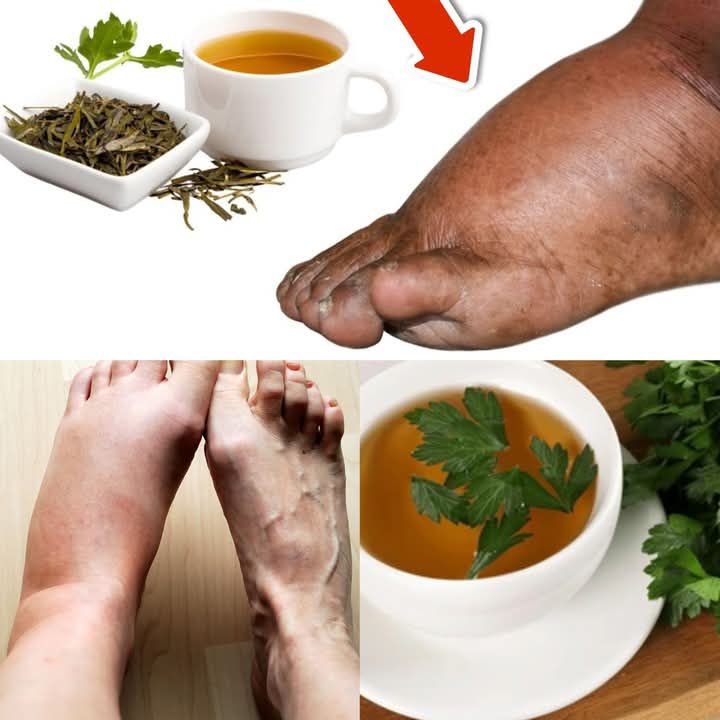 Drink Parsley Tea and Say Goodbye to Swollen Legs, Ankles, and Feet