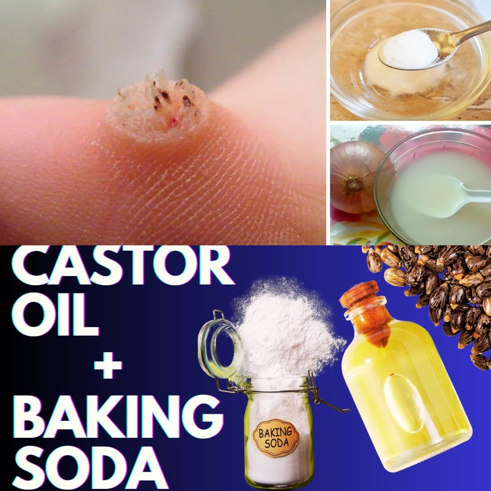 How to Get Rid of Warts Naturally with Castor Oil and Baking Soda