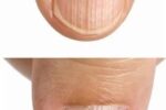 Doctor Explains What It Means If You Have Ridges On Your Fingernails
