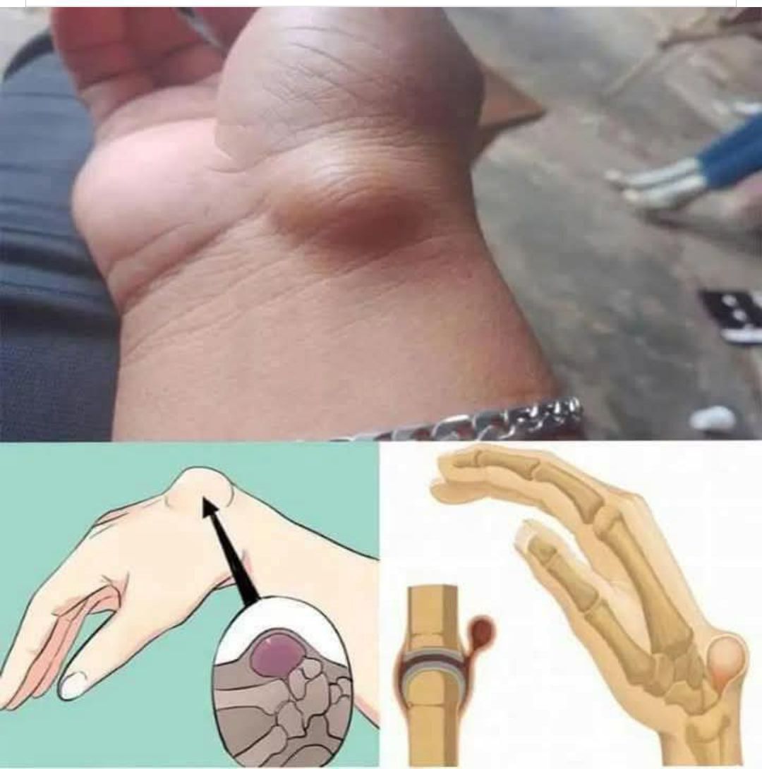 BE CAREFUL, if you get these bruises on your body, it means you have Ca…see more